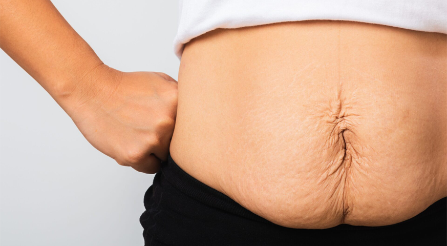 Ozempic Body & Skin Laxity After Weight Loss