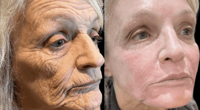 Erbium vs Fractional CO₂ Laser Resurfacing: Why Erbium Can Look “Shockingly” Good